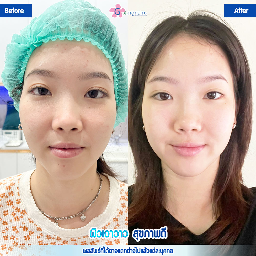 รีวิวหลังฉีด Chanel injection