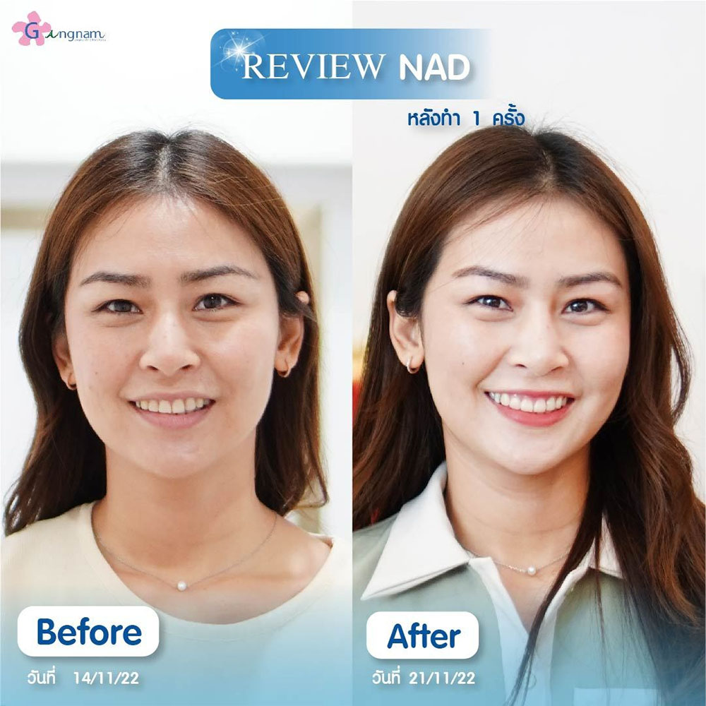รีวิวหลังทำ NAD