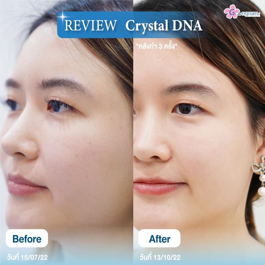 รีวิว Crystal DNA 3 ครั้งหลังทำ