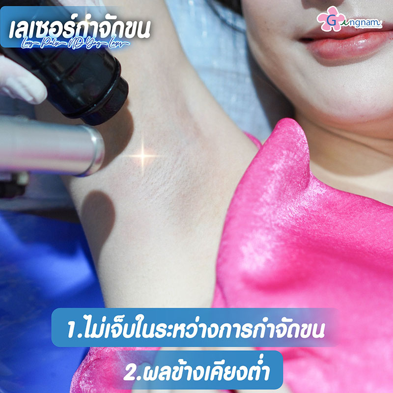 เลเซอร์กำจัดขนรักแร้ เจ็บไหม