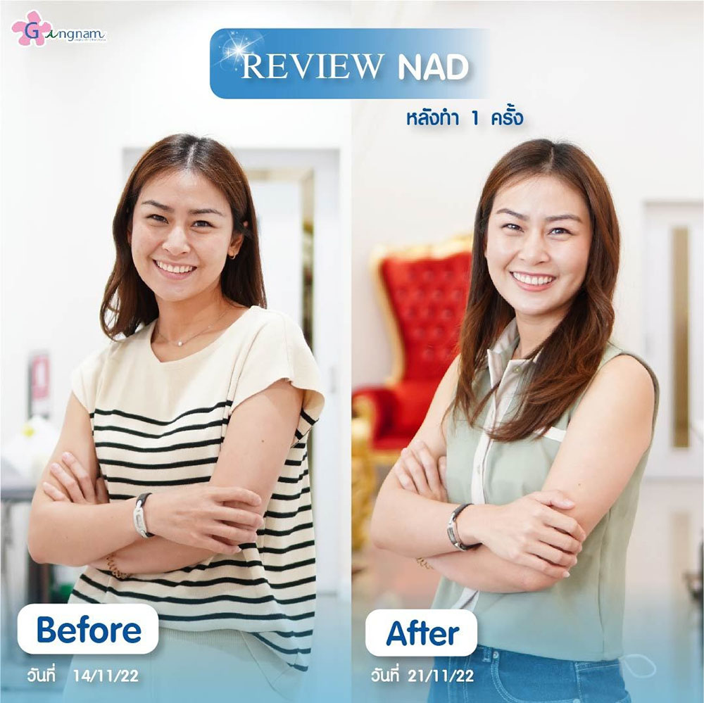 รีวิว NAD+ Therapy หลังทำ 1 ครั้ง