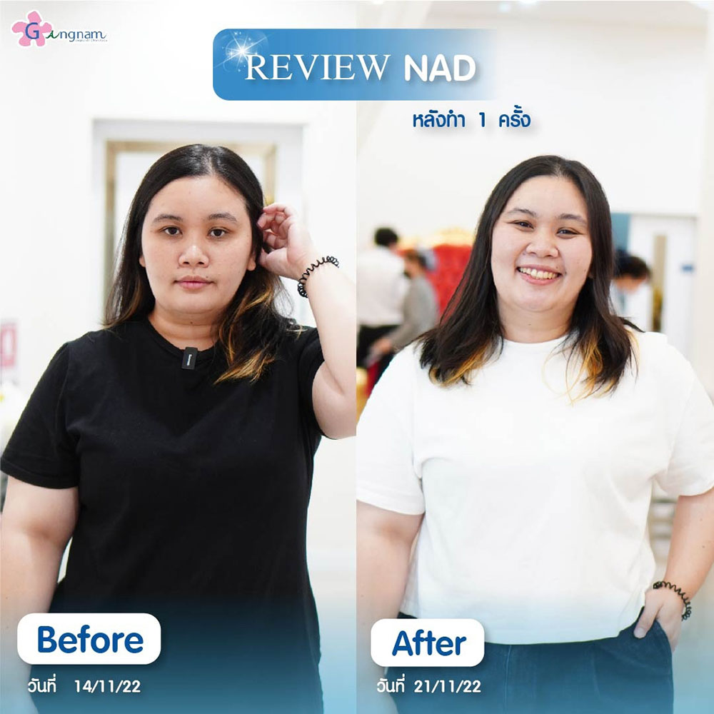 รีวิว NAD+ Therapy หลังทำ