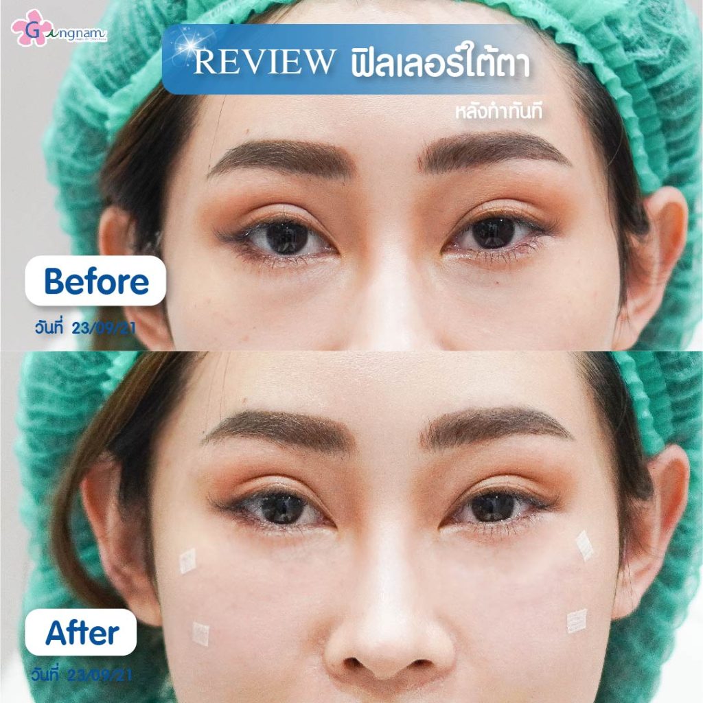 ฉีดฟิลเลอร์ลดริ้วรอยใต้ตา