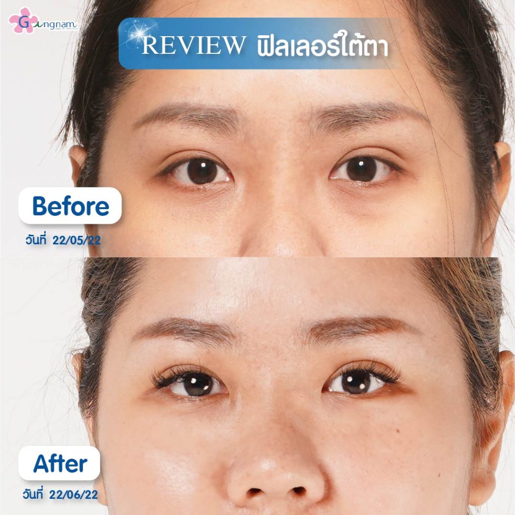 ฉีดฟิลเลอร์แก้ถุงใต้ตา