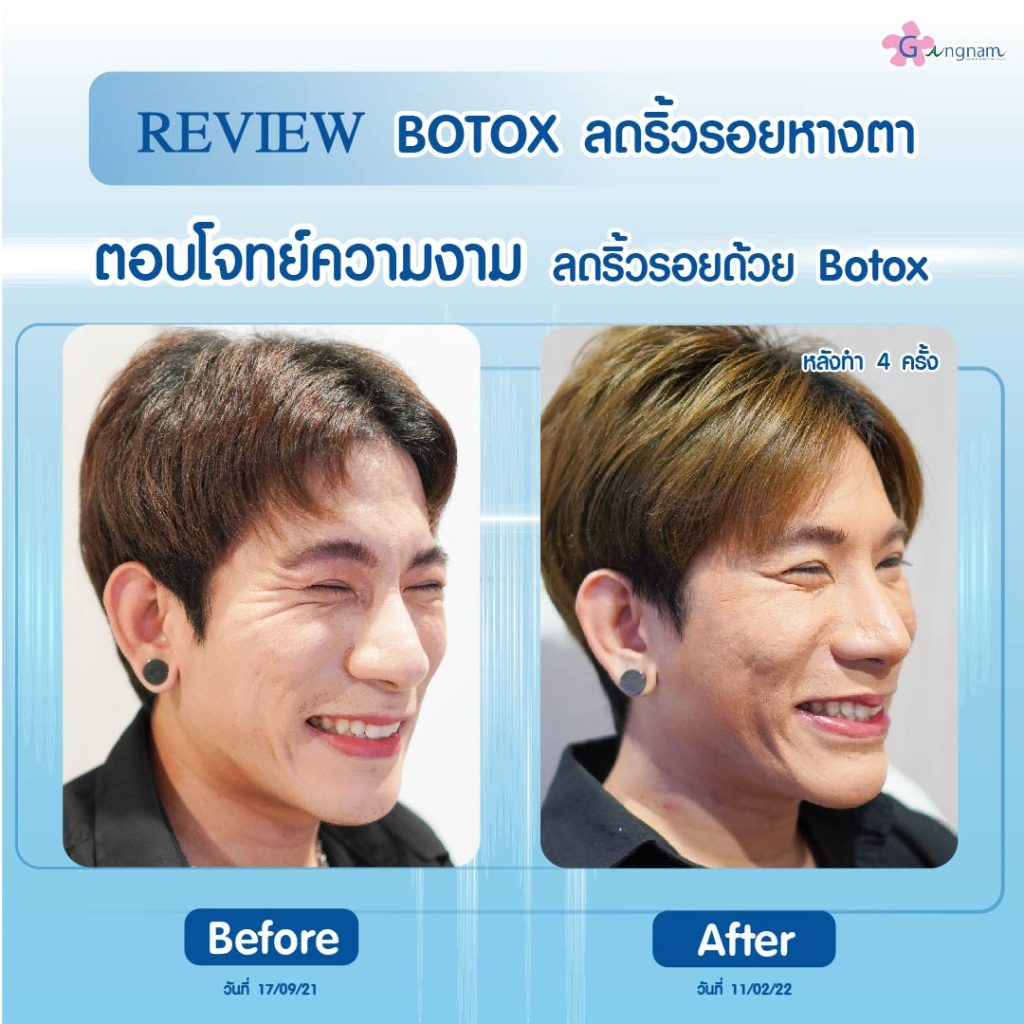 ฉีดโบท็อกลดริ้วรอยหางตา