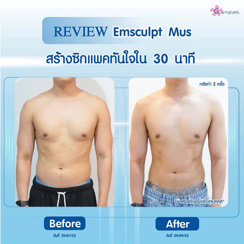 สร้างซิกแพค ลดไขมัน ด้วย Emsculpt