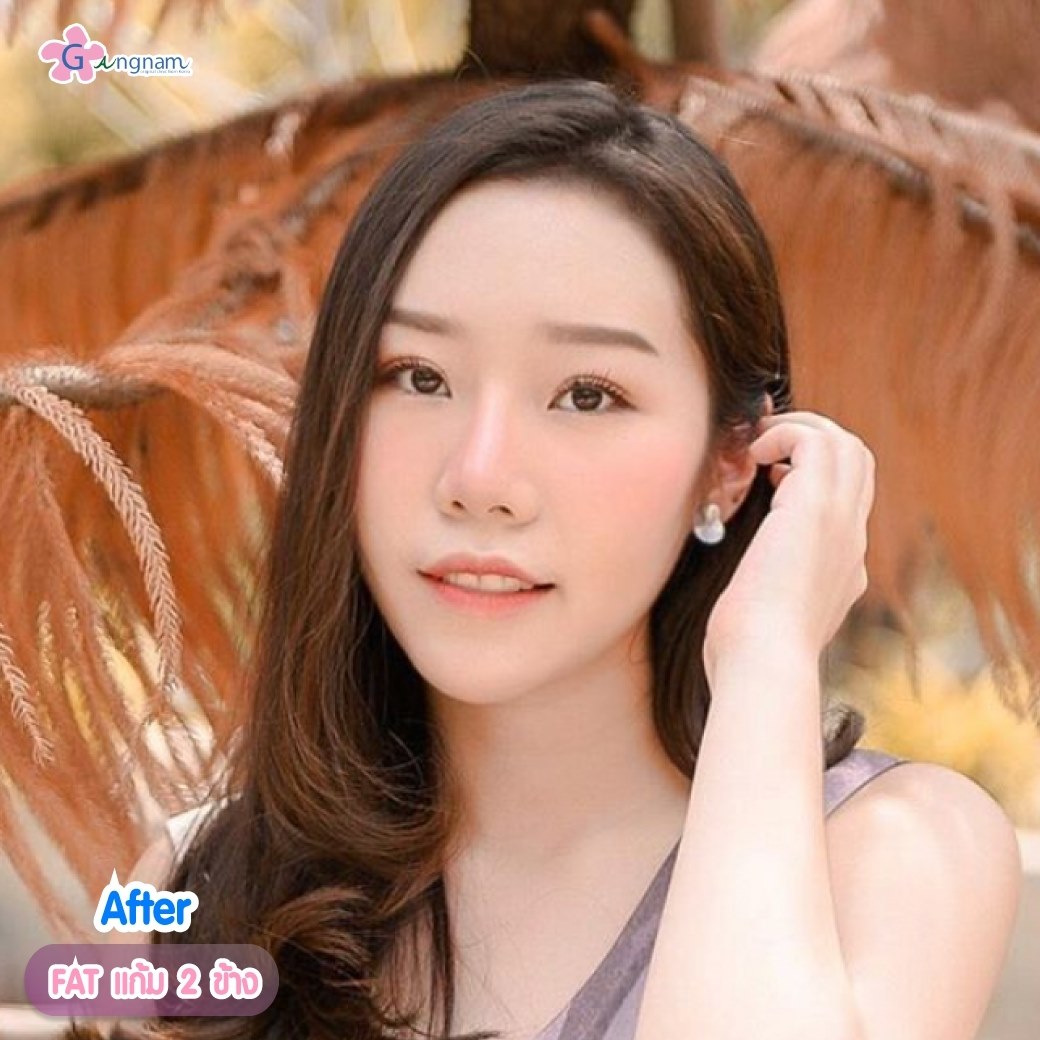 หลังฉีดเมโสแฟตแก้ม