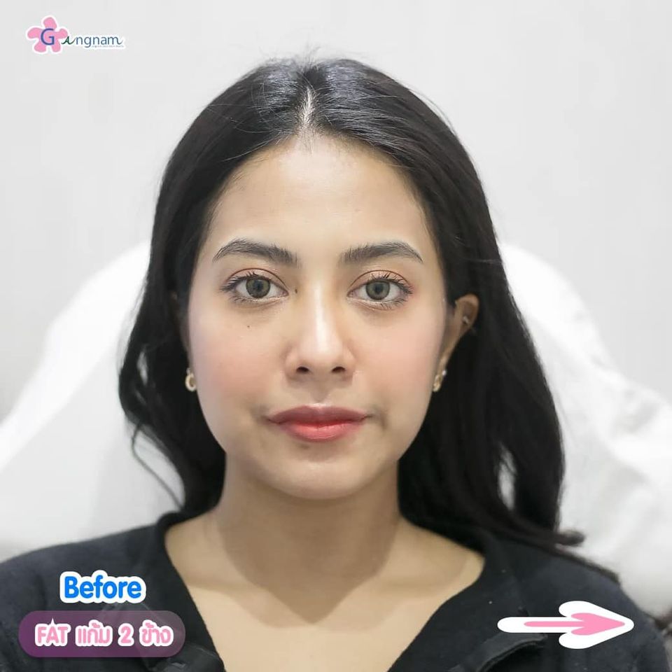 เมโสแฟตแก้ม ก่อนทำ