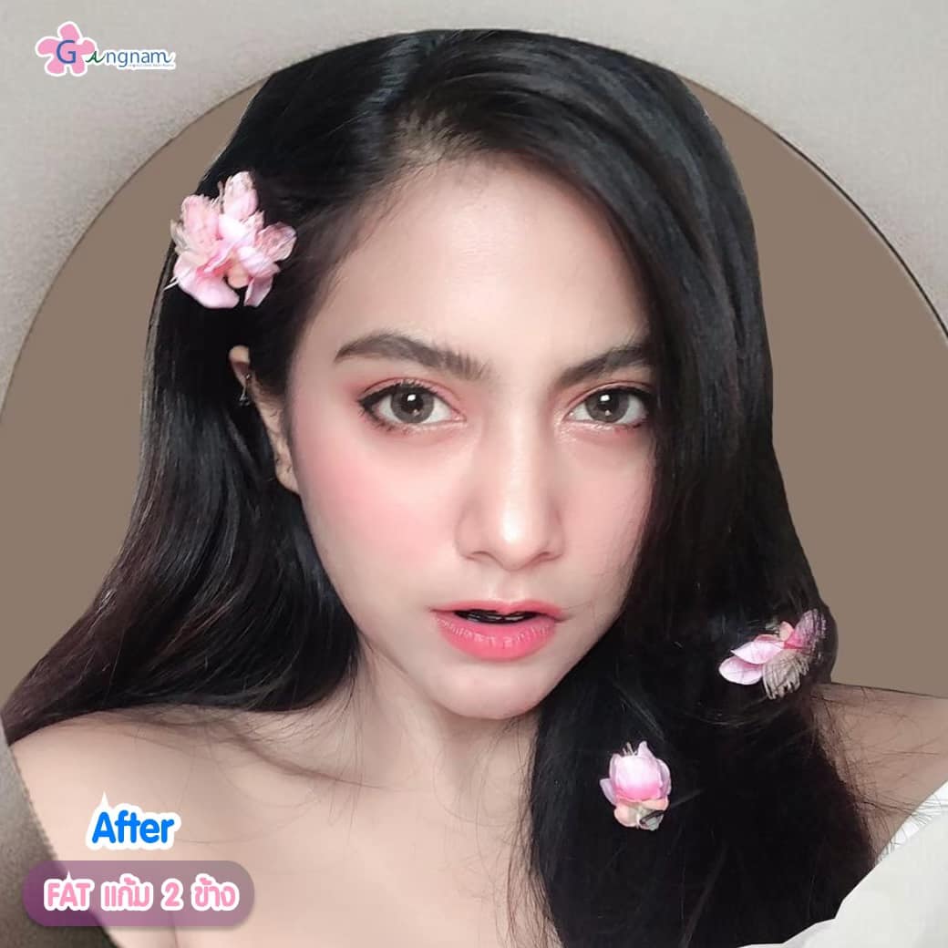 เมโสแฟตแก้ม หลังทำ