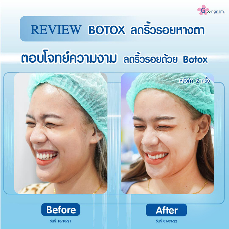 โบท็อกลดริ้วรอย หางตา