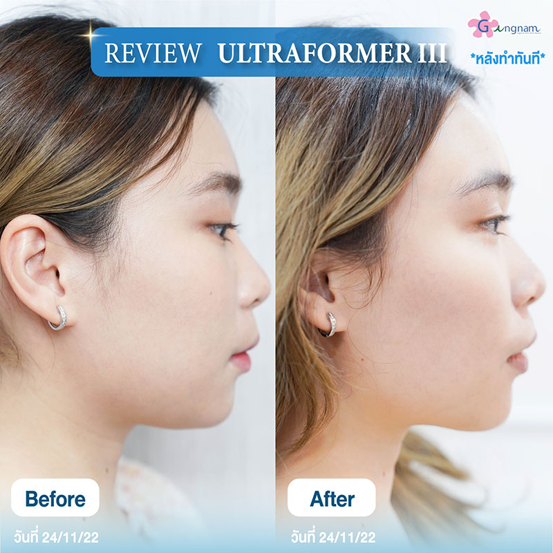 รีวิวยกกระชับหน้า Ultraformer 3