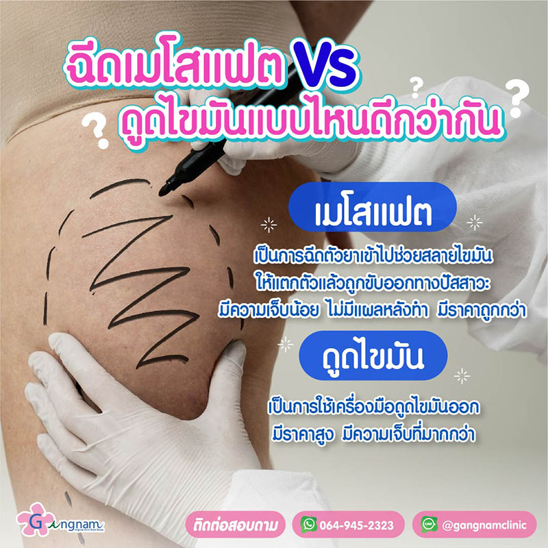 แฟตต้นขา-vs-ดูดไขมันต้นขา