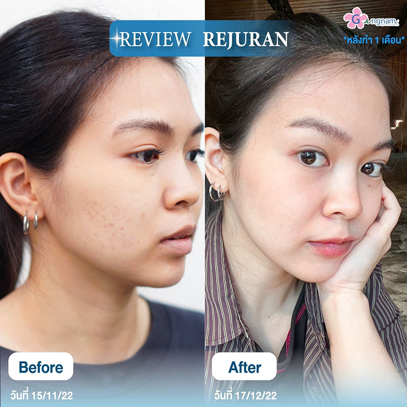 7 วิธีทําให้หน้าใส ไร้สิว วิธีไหนช่วยให้ผิวกระจ่างใสแบบธรรมชาติ และได้ผลจริง 7 วิธีทําให้หน้าใส ไร้สิว วิธีไหนช่วยให้ผิวกระจ่างใสแบบธรรมชาติ และได้ผลจริง