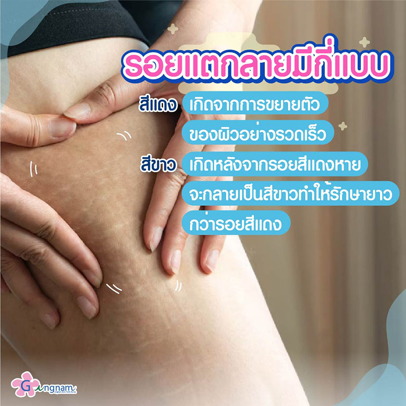 รอยแตกลาย เกิดจากอะไร? มีกี่แบบ ใช้วิธีรักษาต่างกันไหม? รอยแตกลาย เกิดจากอะไร? มีกี่แบบ ใช้วิธีรักษาต่างกันไหม?