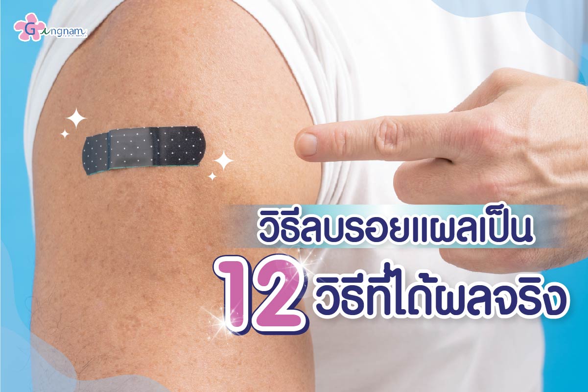 รวม 12 วิธีลบรอยแผลเป็น บนใบหน้าและจุดต่างๆ รักษาด้วยวิธีได้ผลเร็วที่สุด