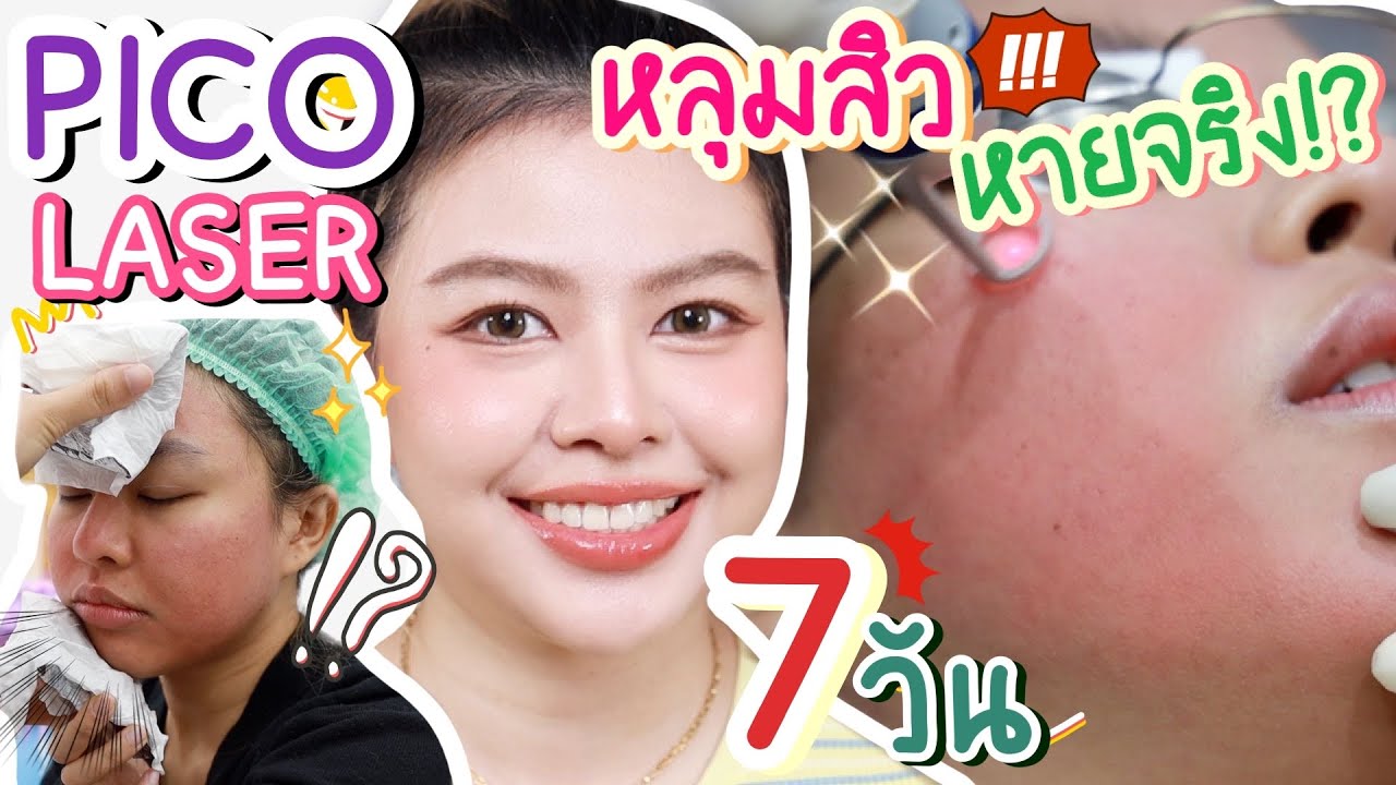 PICO LASER รักษาหลุมสิว