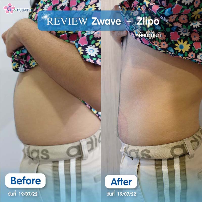 รีวิว ZwaveZlipo ลดพุง