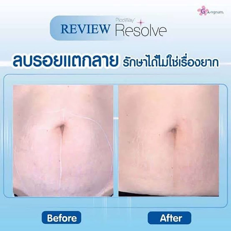 รีวิวการรักษาเลเซอร์รอยแตกลาย