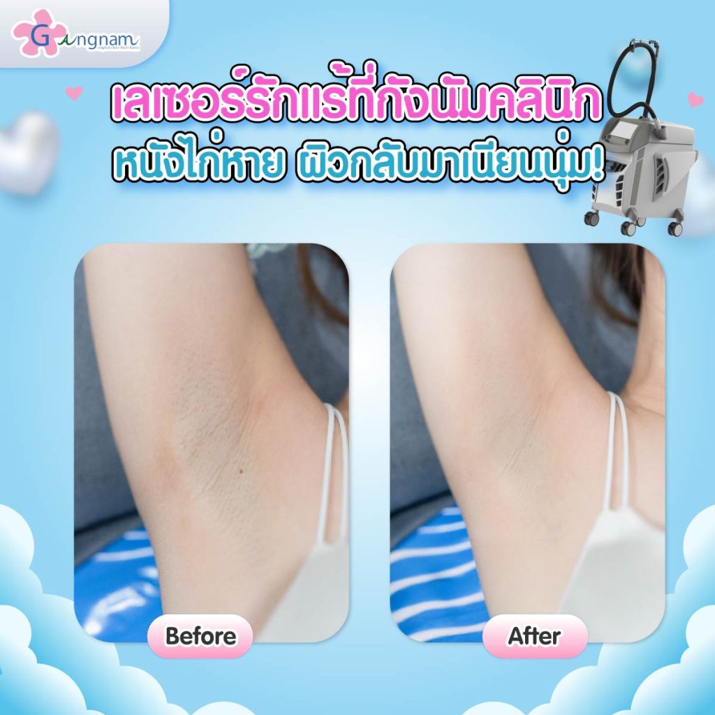 รีวิวเลเซอร์ขนรักแร้ที่กังนัมคลินิก