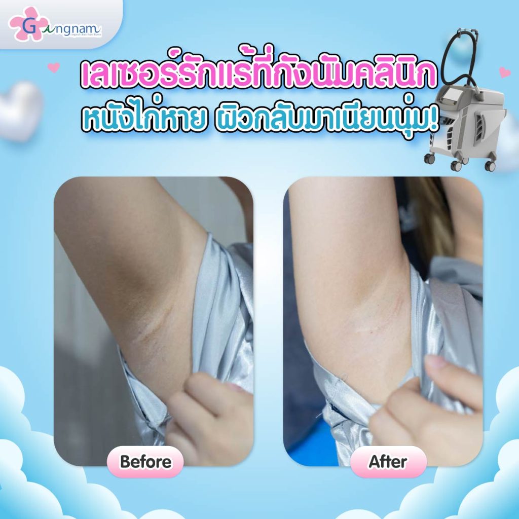 รีวิวเลเซอร์ขนรักแร้ที่กังนัมคลินิก