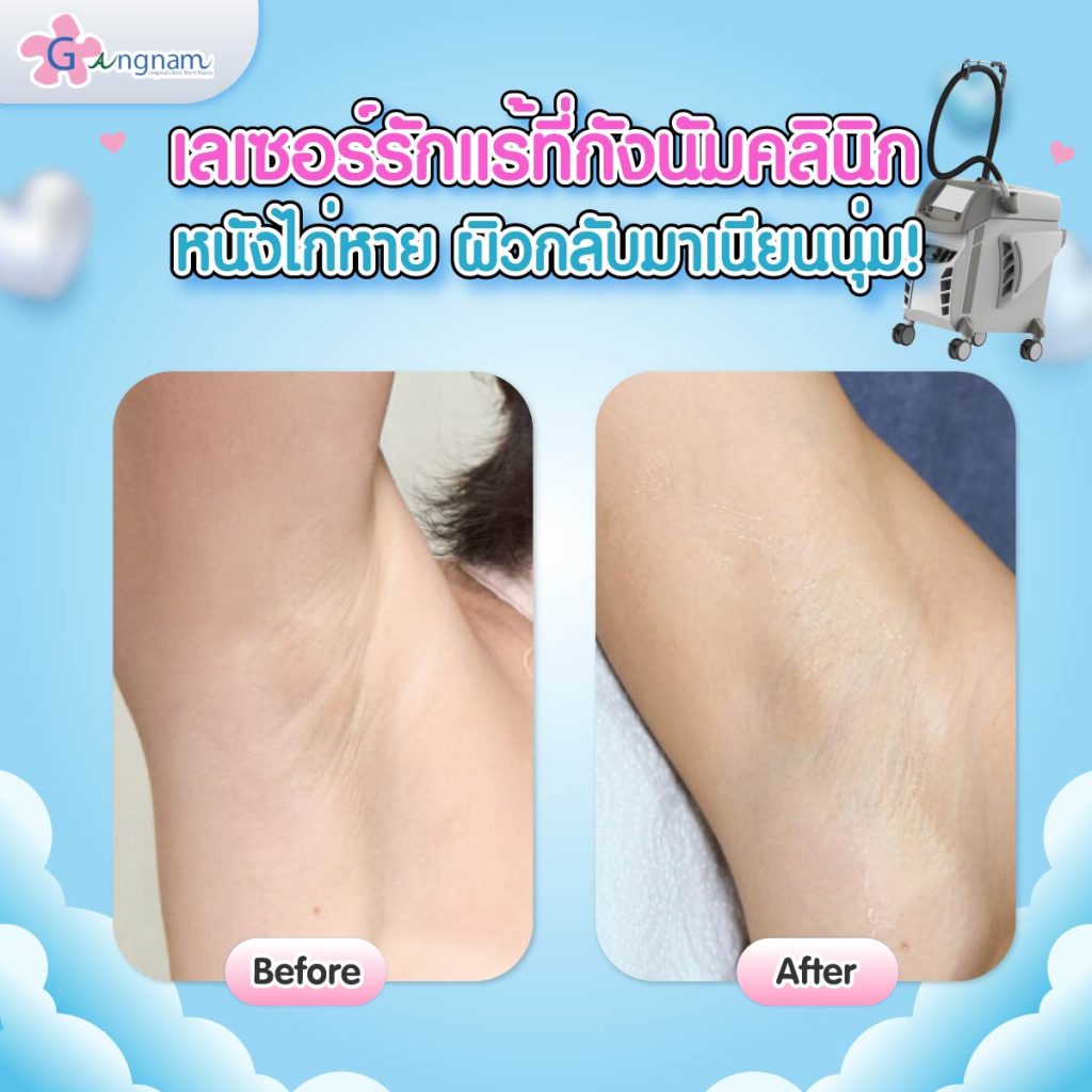 รีวิวเลเซอร์ขนรักแร้ที่กังนัมคลินิก