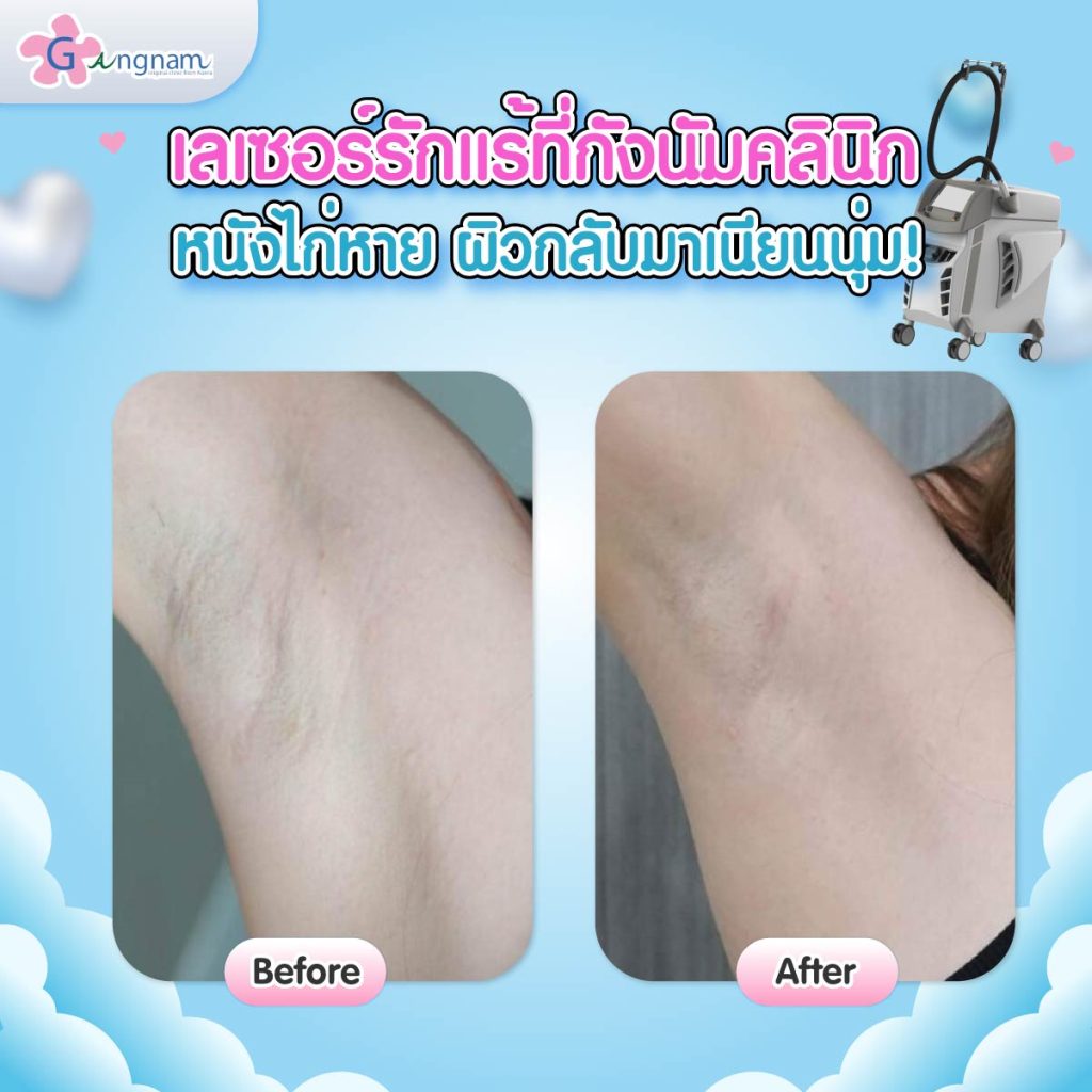 รีวิวเลเซอร์ขนรักแร้ที่กังนัมคลินิก