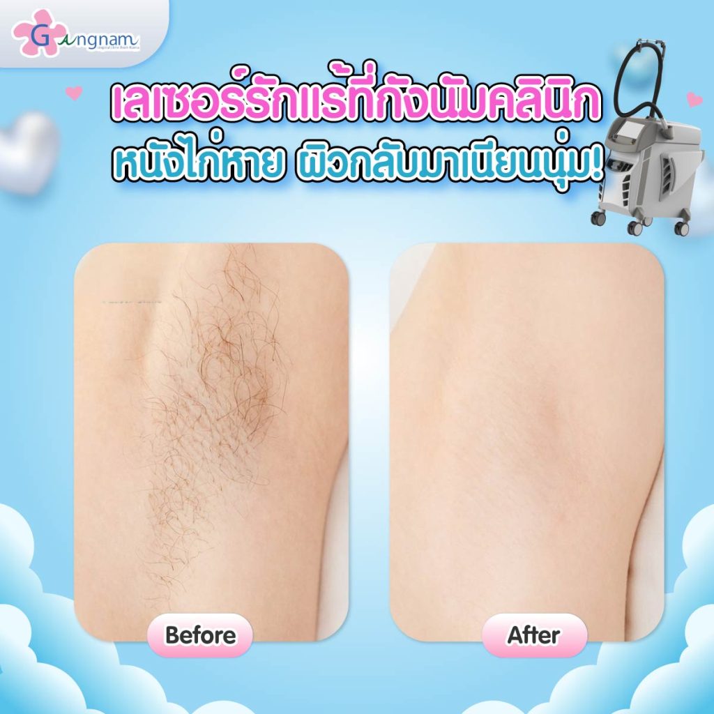 รีวิวเลเซอร์ขนรักแร้ที่กังนัมคลินิก