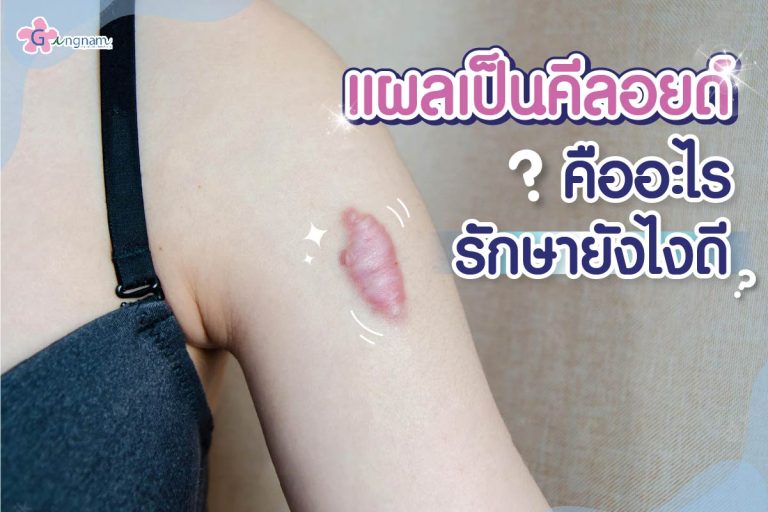 แผลเป็นคีลอยด์ (Keloid) คือ? เกิดจากอะไร? พร้อมรู้วิธีรักษาให้รอยนูนยุบลง