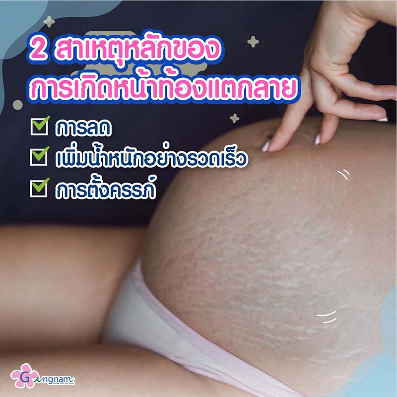 หน้าท้องแตกลายหลังคลอด หายเองได้ไหม? มีวิธีแก้และรักษาอย่างไร - Gangnam  Clinic