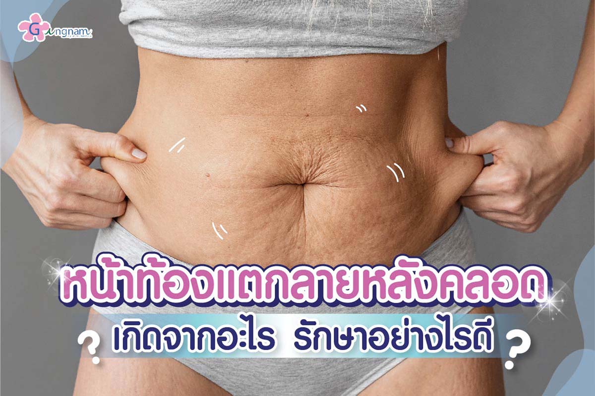 หน้าท้องแตกลายหลังคลอด หายเองได้ไหม? มีวิธีแก้และรักษาอย่างไร - Gangnam  Clinic