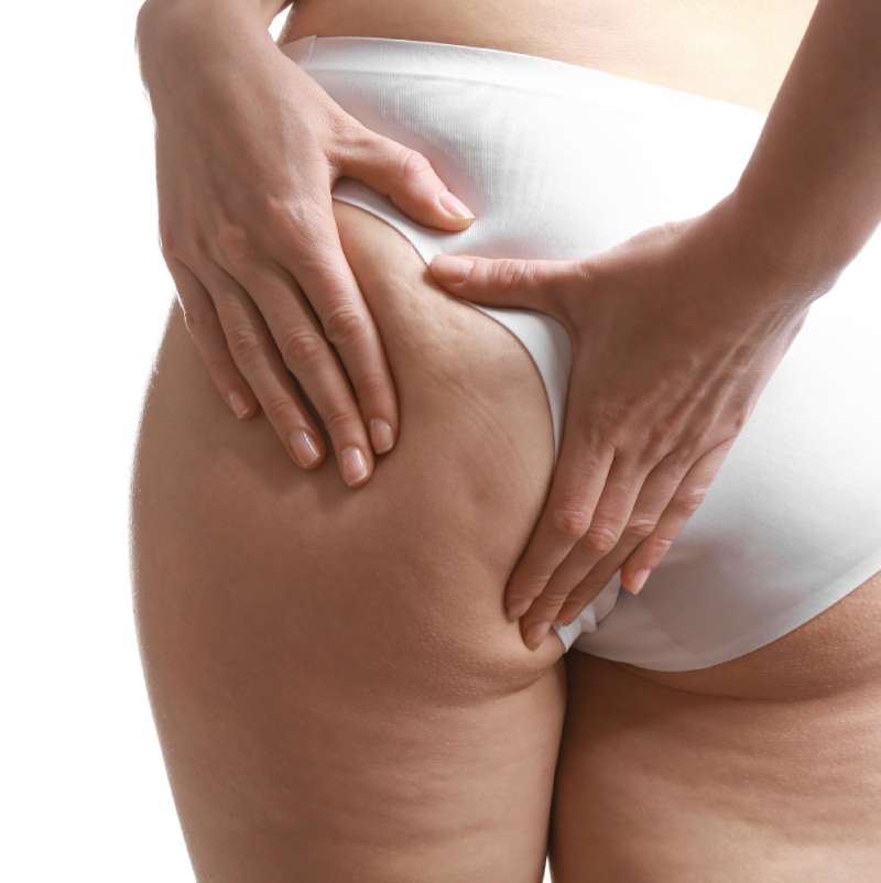 เซลลูไลท์ (Cellulite) คืออะไร? มีวิธีลดและกำจัดเซลลูไลท์อย่างไรให้เห็นผล - Gangnam Clinic เซลลูไลท์ (Cellulite) คืออะไร? มีวิธีลดและกำจัดเซลลูไลท์อย่างไรให้เห็นผล - Gangnam Clinic