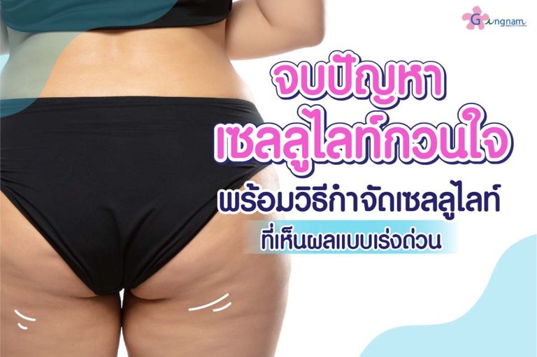 เซลลูไลท์ (Cellulite) คืออะไร? มีวิธีลดและกำจัดเซลลูไลท์อย่างไรให้เห็นผล