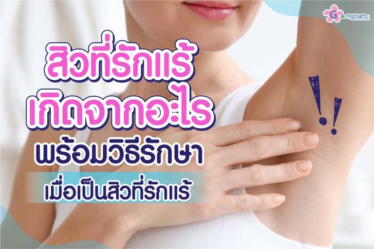 5 สาเหตุสิวที่รักแร้ เกิดจากอะไร? พร้อมวิธีป้องกันและรักษา