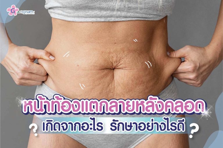 หน้าท้องแตกลายหลังคลอด หายเองได้ไหม? มีวิธีแก้และรักษาอย่างไร