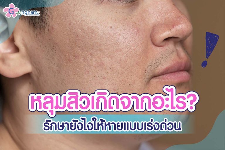 หลุมสิว เกิดจากอะไร มีกี่แบบ ใช้วิธีรักษาต่างกันไหม?