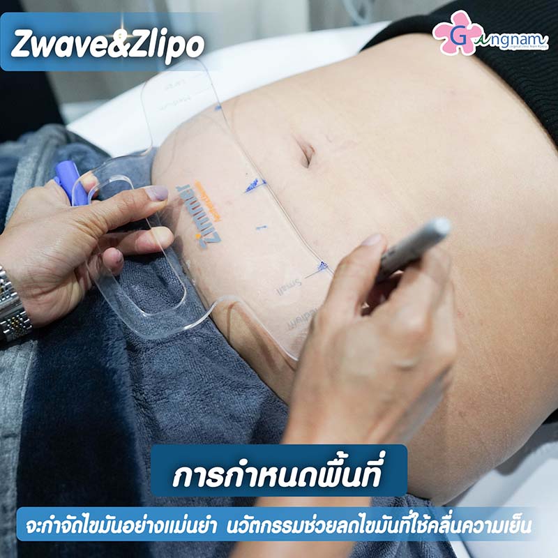 แก้ปัญหาอ้วนลงพุงด้วย zwave zlipo