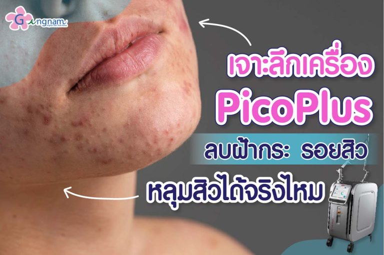 PicoPlus laser คืออะไร ช่วยแก้ปัญหาเรื่องผิวแบบไหน เหมาะกับใครบ้าง ดีจริงไหม?