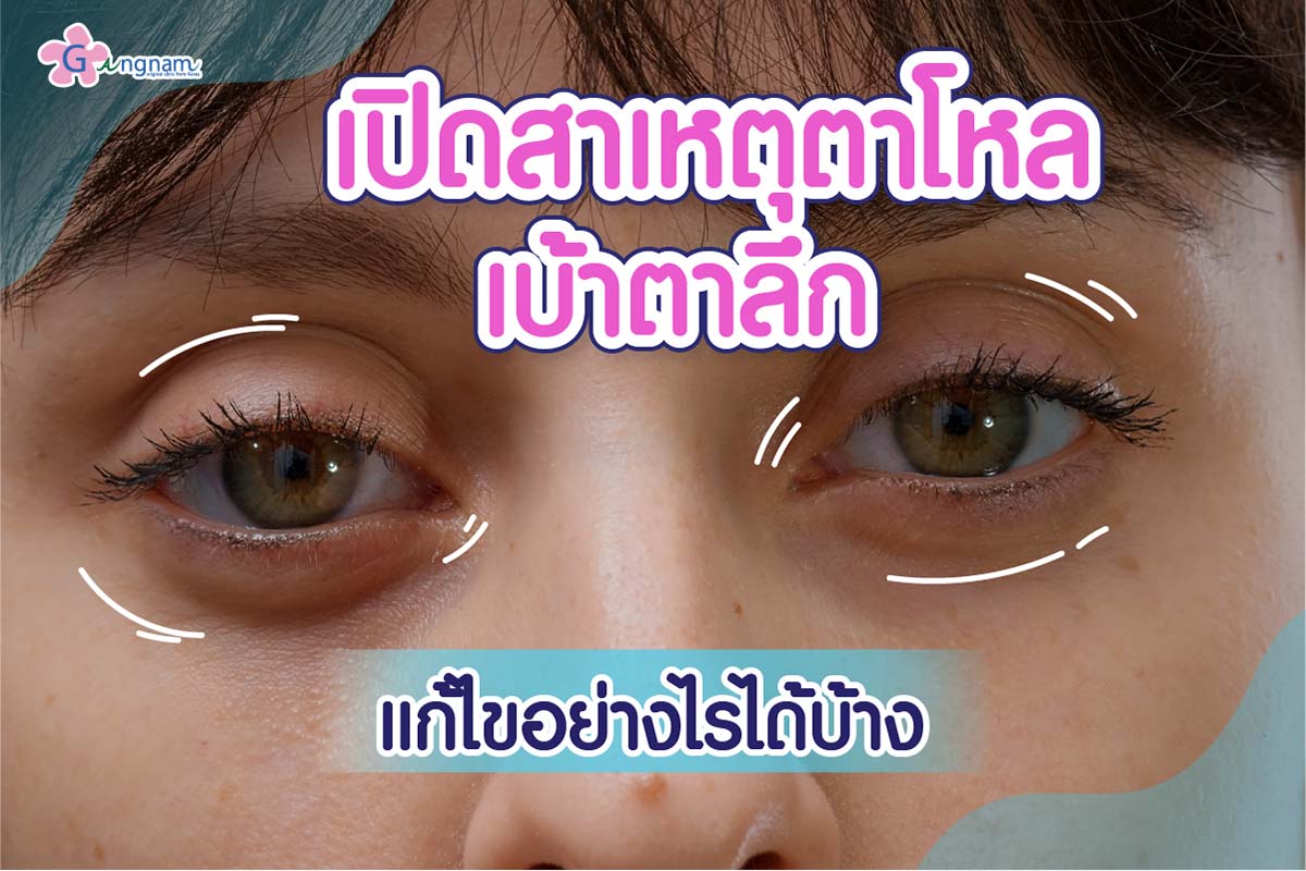 ตาโหล เบ้าตาลึกทำไงดี? มารู้จักสาเหตุและวิธีแก้ตาโหลให้กลับมาสดใสอีก ...