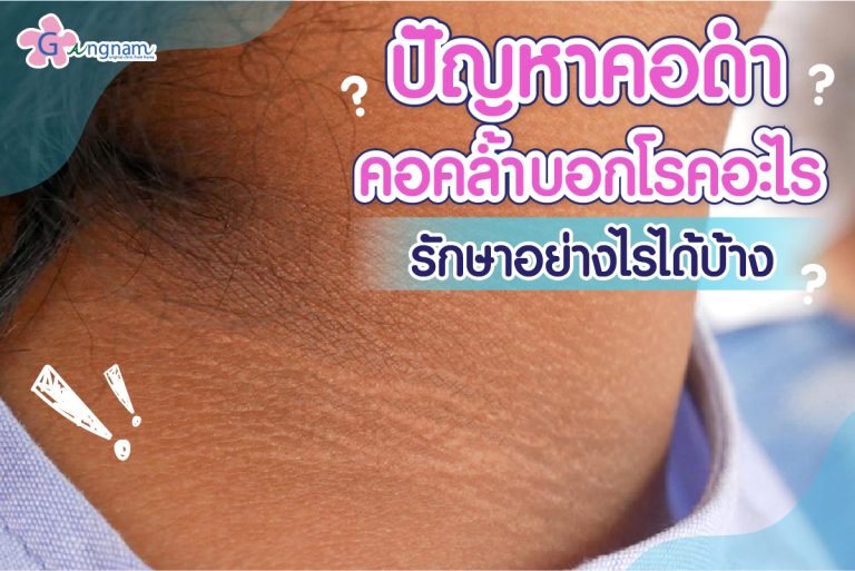 ปัญหาคอดำ คอคล้ำบอกโรคอะไร รักษาอย่างไรได้บ้าง