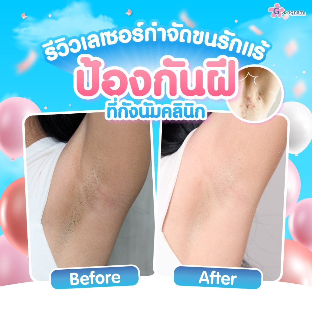 รีวิวเลเซอร์ขนรักแร้