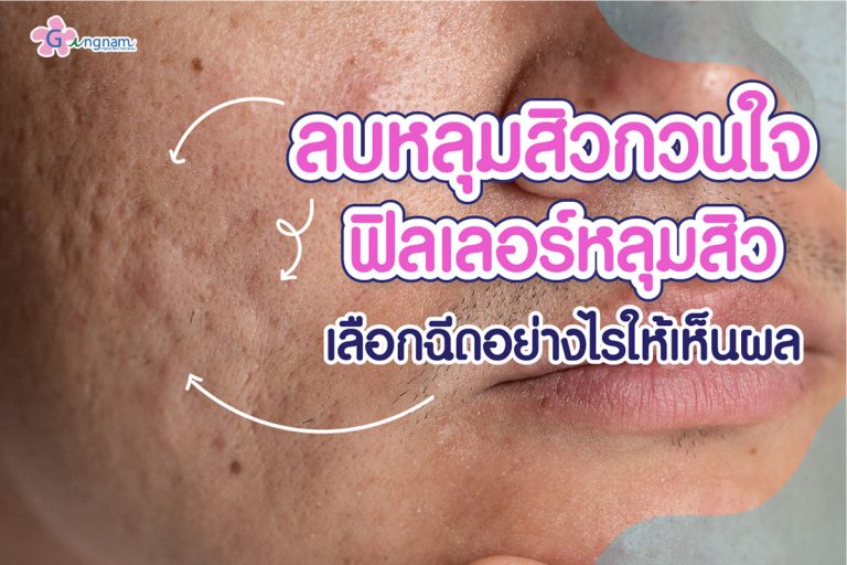 ฉีดฟิลเลอร์หลุมสิว เหมาะกับใช้ฉีดเติมเต็มหลุมสิวแบบไหน? ฉีดกี่ครั้งถึงเห็นผล