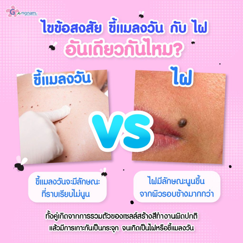 ขี้แมลงวัน กับ ไฝเหมือนหรือต่างกันอย่างไร