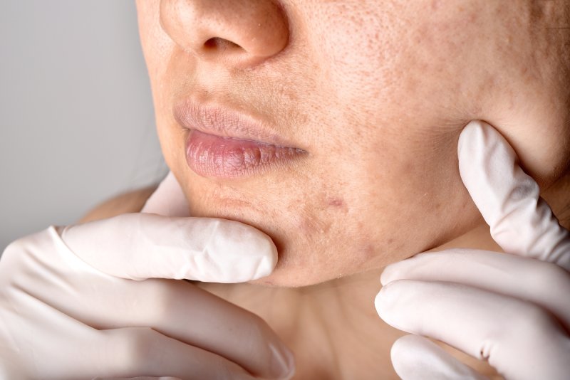 PicoSure laser ช่วยอะไรบ้าง