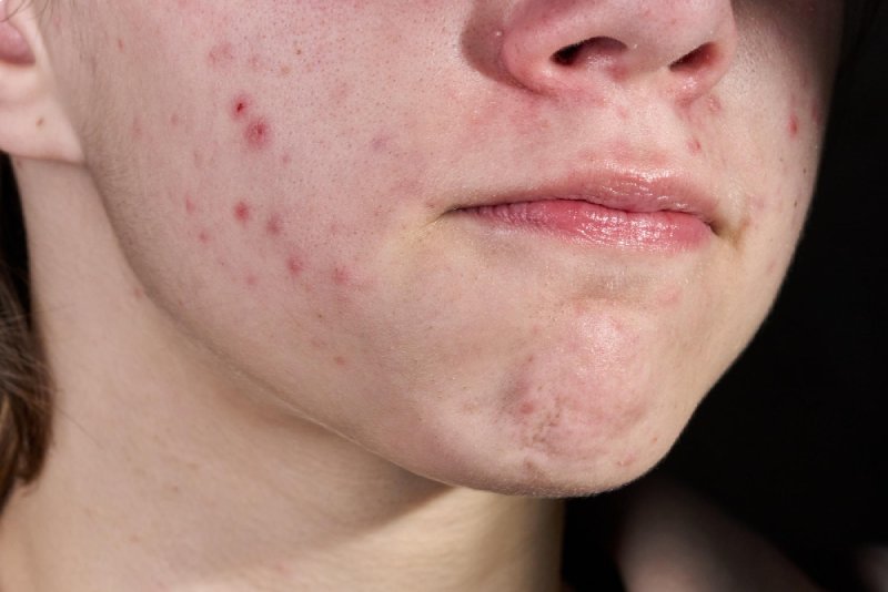 สิวอักเสบ (Inflamed acne)