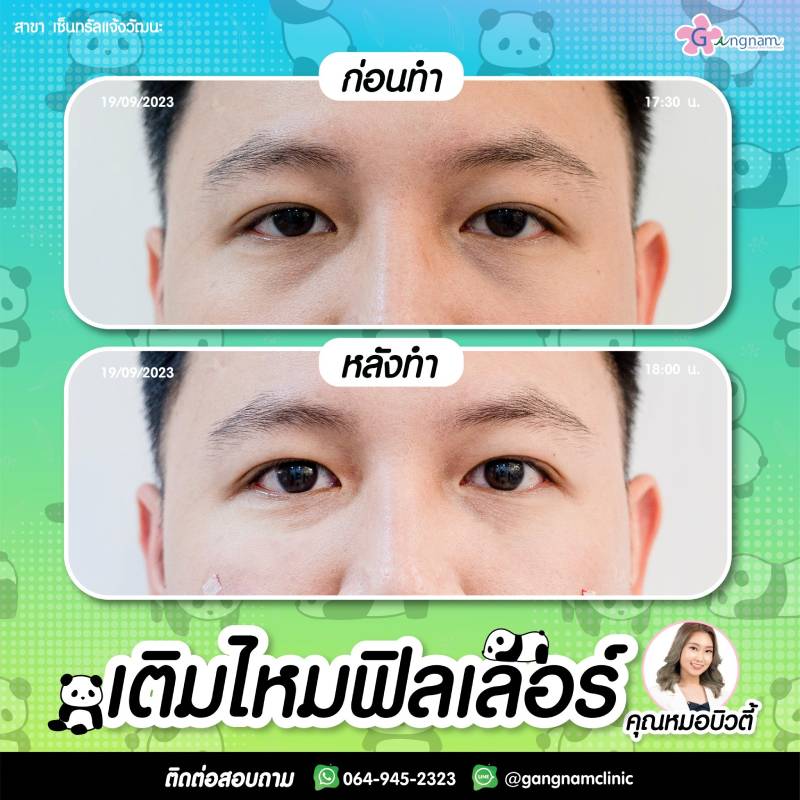 รอยไหมฟิลเลอร์