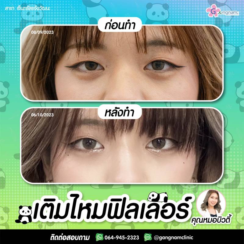 ร้อยไหมฟิลเลอร์ใต้ตา