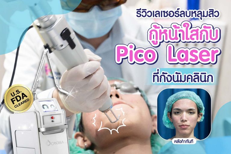 รวมเคส รีวิว Pico Laser รักษาหลุมสิว รอยสิว ฝ้า กระ ที่กังนัมคลินิก