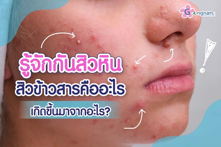 รู้จักกับ สิวหิน สิวข้าวสาร คืออะไร ป้องกันและรักษาด้วยวิธีไหนได้บ้าง?