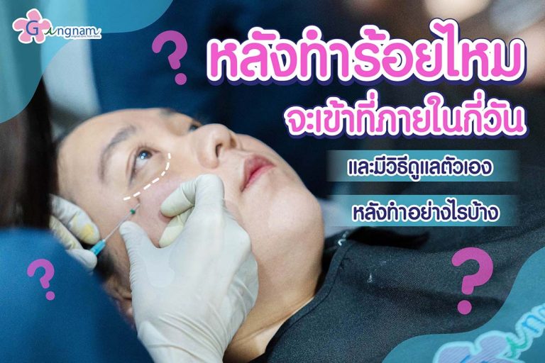 หลังทำร้อยไหมจะเข้าที่ภายในกี่วัน บวมกี่วัน? และมีวิธีดูแลตัวเองหลังทำอย่างไรบ้าง